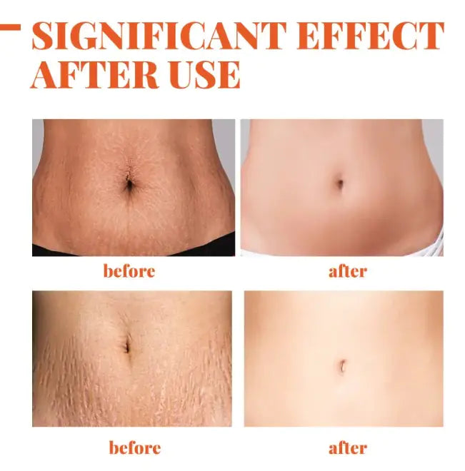 EELHOE Scar & Stretch Mark Repairing Essential Oil